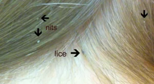 to How Long You Had Lice? Lice Aunties